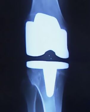 X -Ray foto van de knie met een kunstmatige prothese na de operatie om het gewricht te veranderen