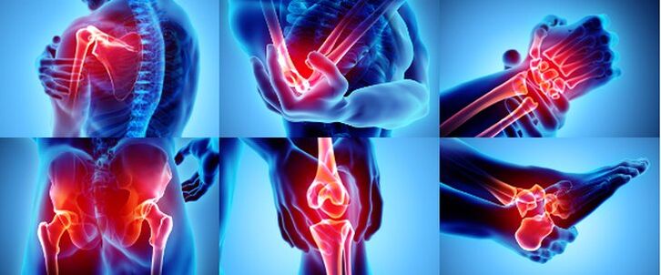 Ontstoken gewrichten