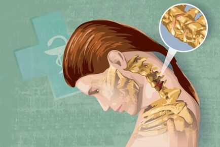 Reflexsymptomen van osteochondrose